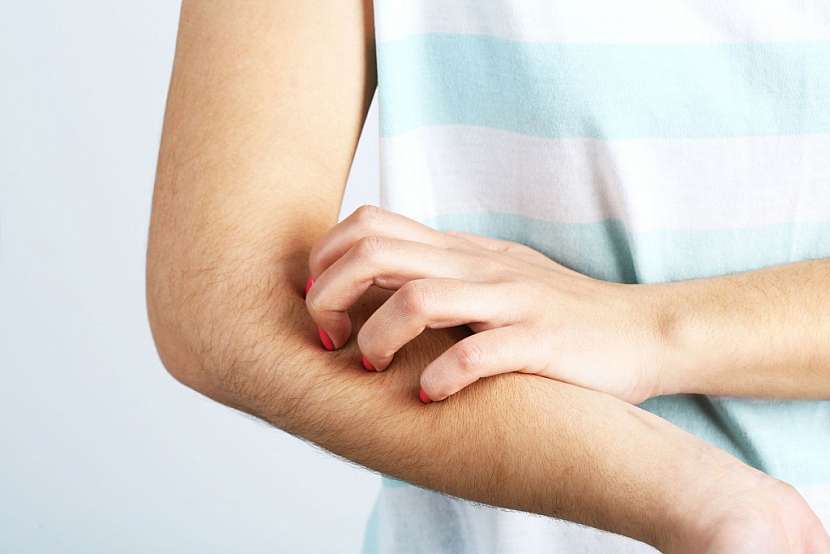 Pokousaná kůže štěnicemi může svědět až za několik hodin