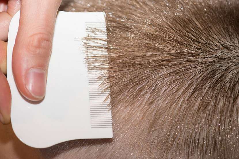 Důkladná kontrola hlavy a vyčesávání speciálním hřebínkem všiváčkem pomůže se vší zbavit