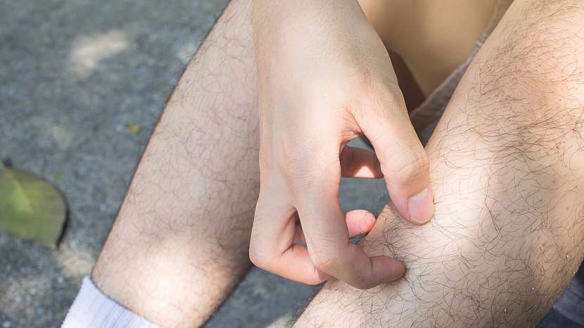 Vodnaté puchýřky jsou jasným signálem, že sametky řádí