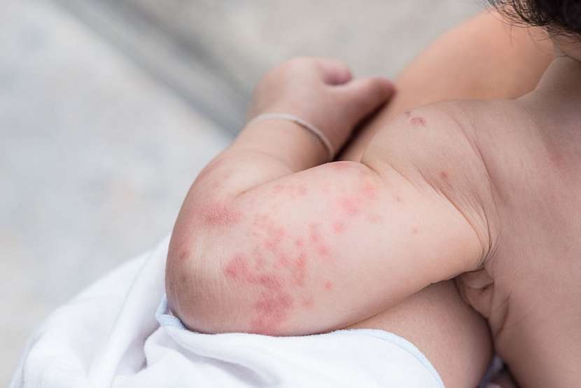 Čisticí prostředky můžou podráždit citlivou dětskou pokožku