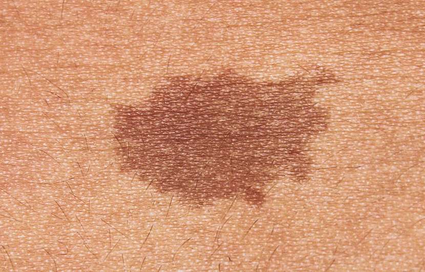 Pigmentové skvrny jsou místa na kůži, která mají jiné zbarvení
