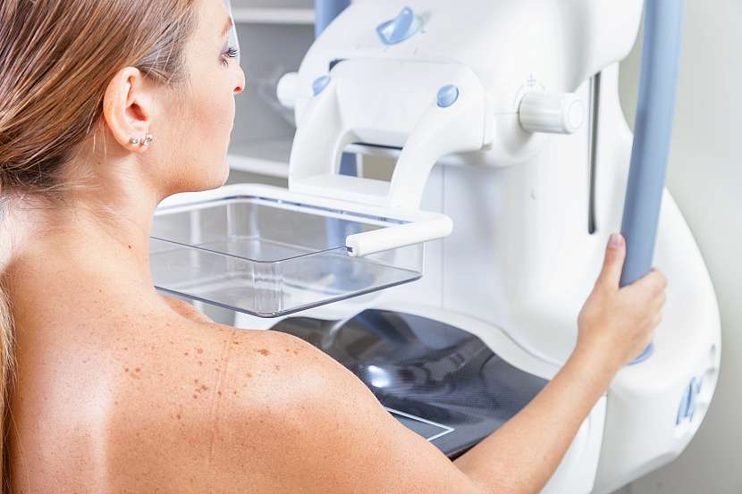 Mamografický screening může odhalit změny ještě předtím, než jsou hmatné nebo způsobují obtíže