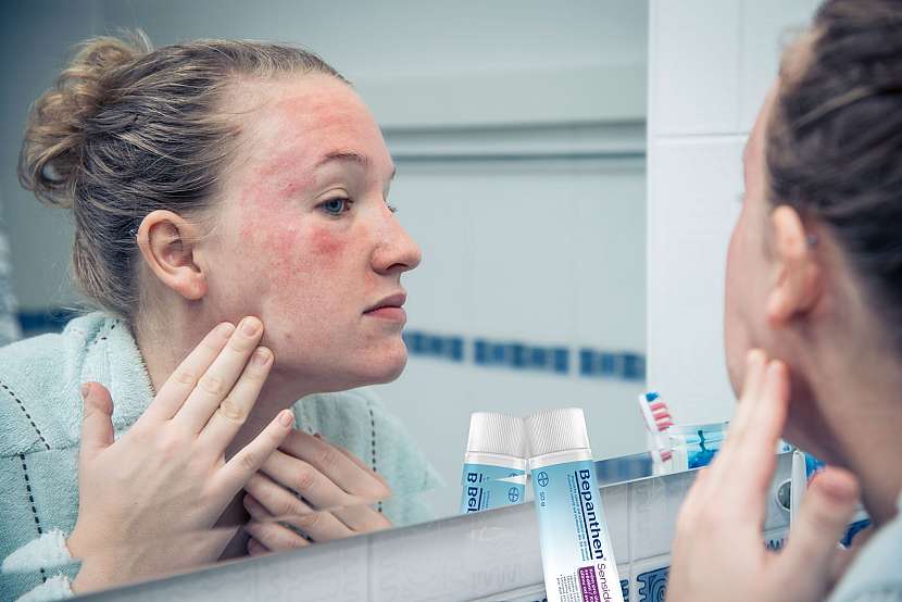 Při péči o postiženou kůži je třeba vhodný krém či mast