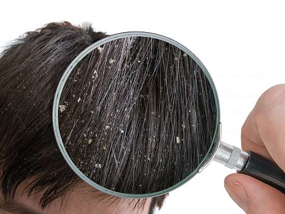 11 rad jak se zbavit lupů a mít zdravou pokožku hlavy (Zdroj: Depositphotos (https://cz.depositphotos.com))