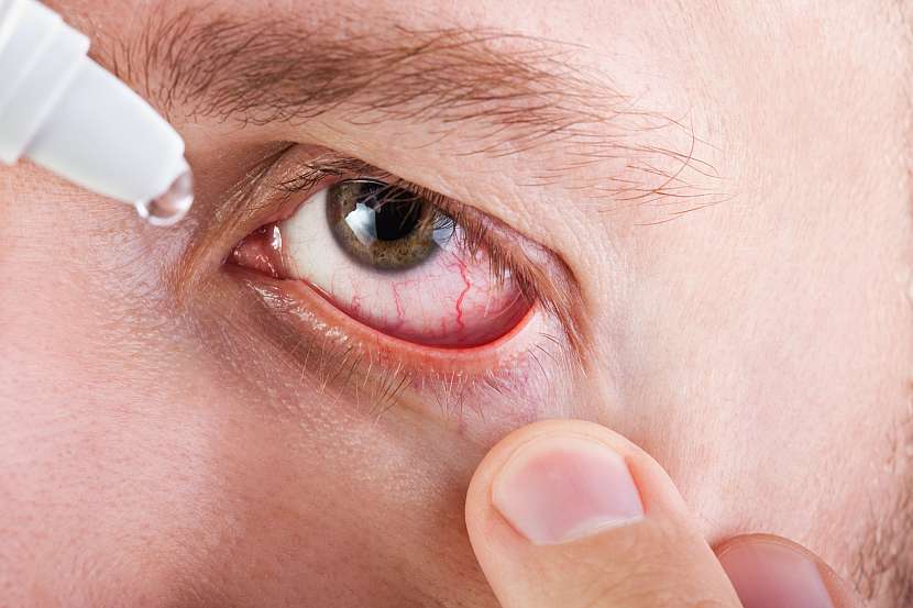 Podrážděné suché oko lze zvlhčit očními kapkami