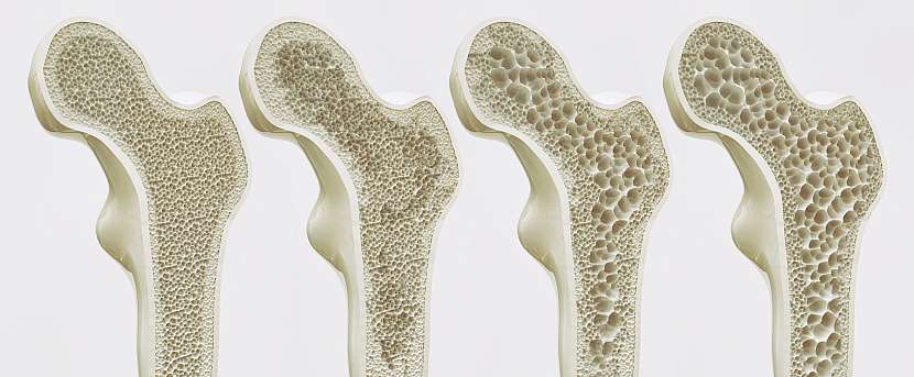 Osteoporóze se přezdívá „tichý zloděj kostí“ 
