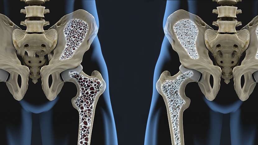 Osteoporóza svůj příchod nehlásí (Zdroj: Vanilla)