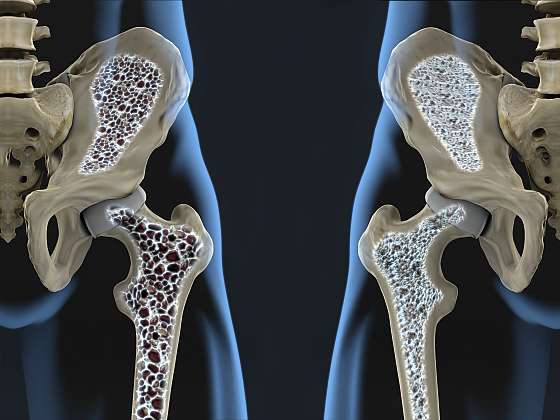 Otevřít článek/video: Světový den osteoporózy
