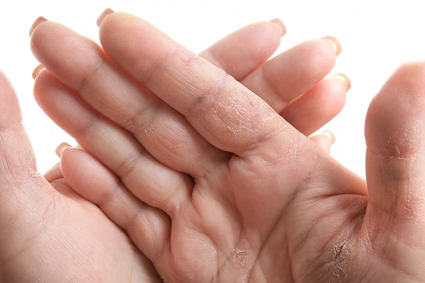 Popraskaná kůže v zimě vyžaduje zvýšenou péči (Zdroj: Depositphotos)