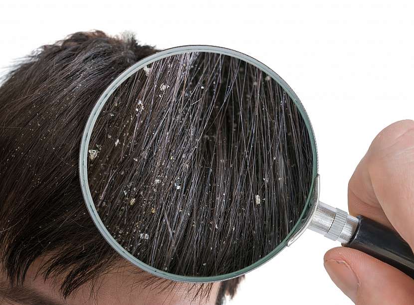 11 rad jak se zbavit lupů a mít zdravou pokožku hlavy (Zdroj: Depositphotos (https://cz.depositphotos.com))